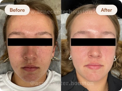 Acne_Before_After_5