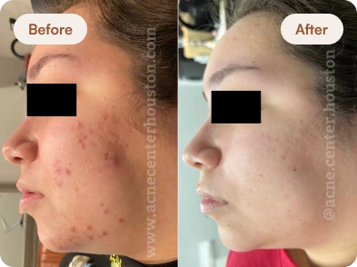 Acne_Before_After_6
