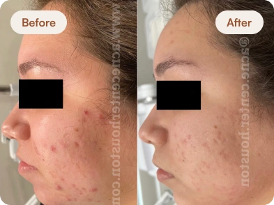 Acne_Before_After_7