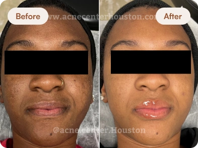 Acne_Before_After_8