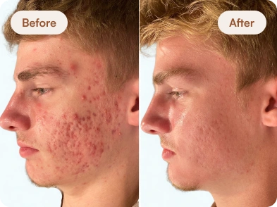 Acne_Before_After_9